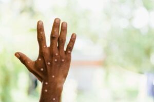 Lakes State declares Mpox outbreak among prison inmates