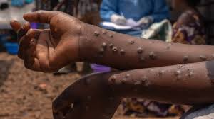 Lakes State declares Mpox outbreak among prison inmates