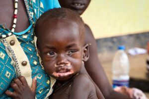 Abyei records 17 measles cases, 1 death