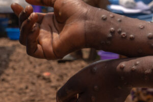 Ezo County reports three Mpox cases