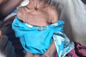 سوء التغذية يهدد حياة مئات الأطفال في جبل مرة