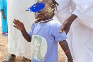 أمراض جلدية تثير مخاوف وسط الأطفال في شمال دارفور