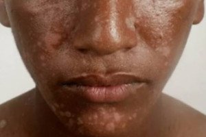 Skin diseases on the rise among children in North Darfur’s Abdelshakur