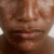 Skin diseases on the rise among children in North Darfur’s Abdelshakur